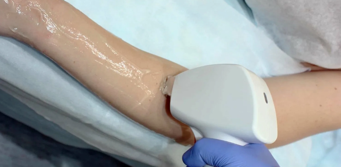 Лазерная эпиляция рук на аппарате Soprano Titanium в Санкт-Петербурге