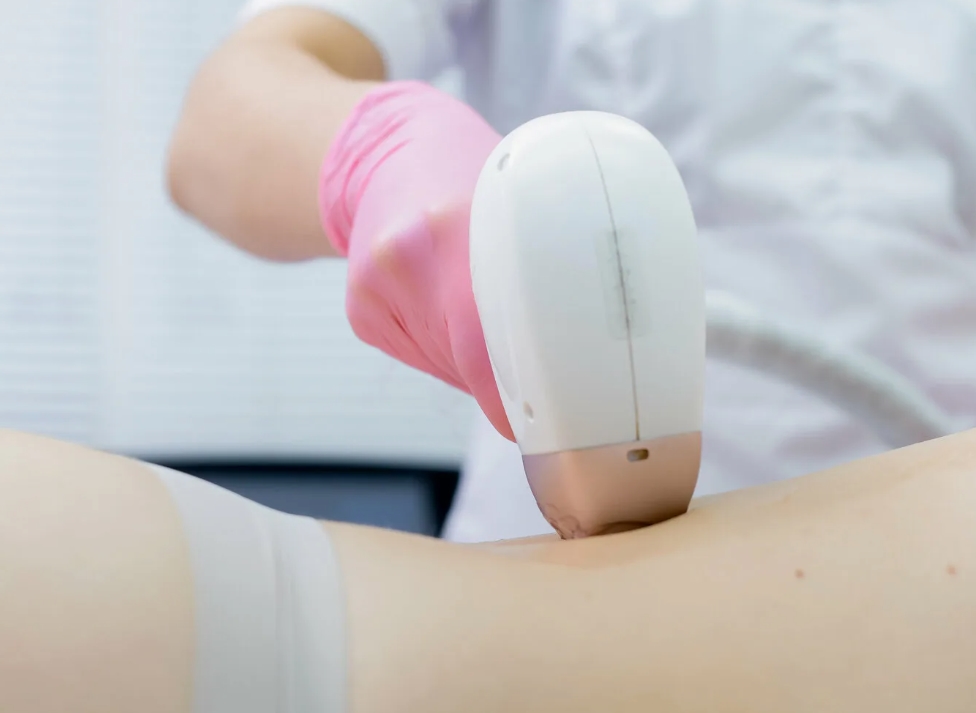 Лазерная эпиляция поясницы на аппарате Soprano Titanium в Санкт-Петербурге