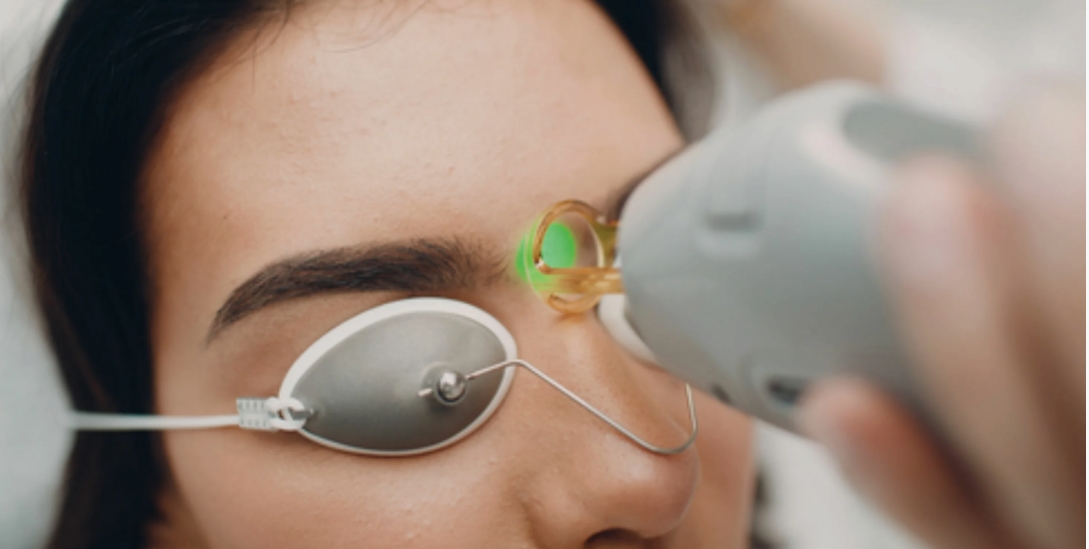 Лазерная эпиляция бровей на аппарате Сопрано Титаниум