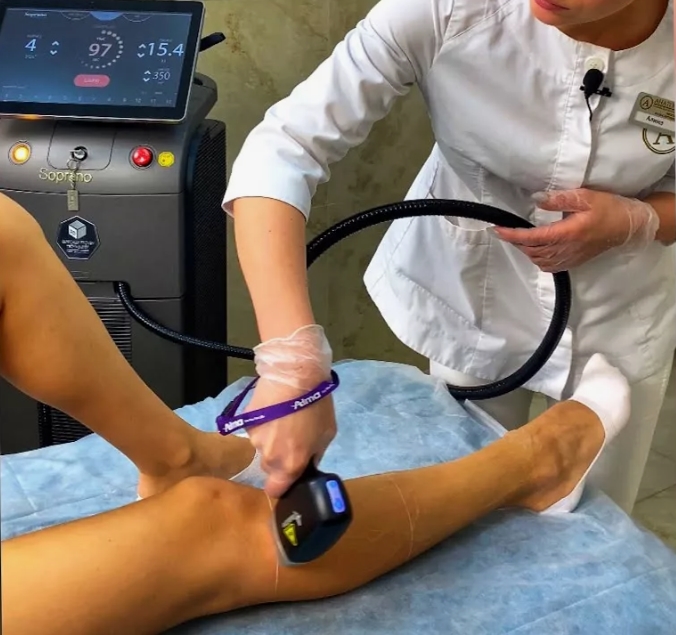 Лазерная эпиляция голеней на аппарате Сопрано Титаниум