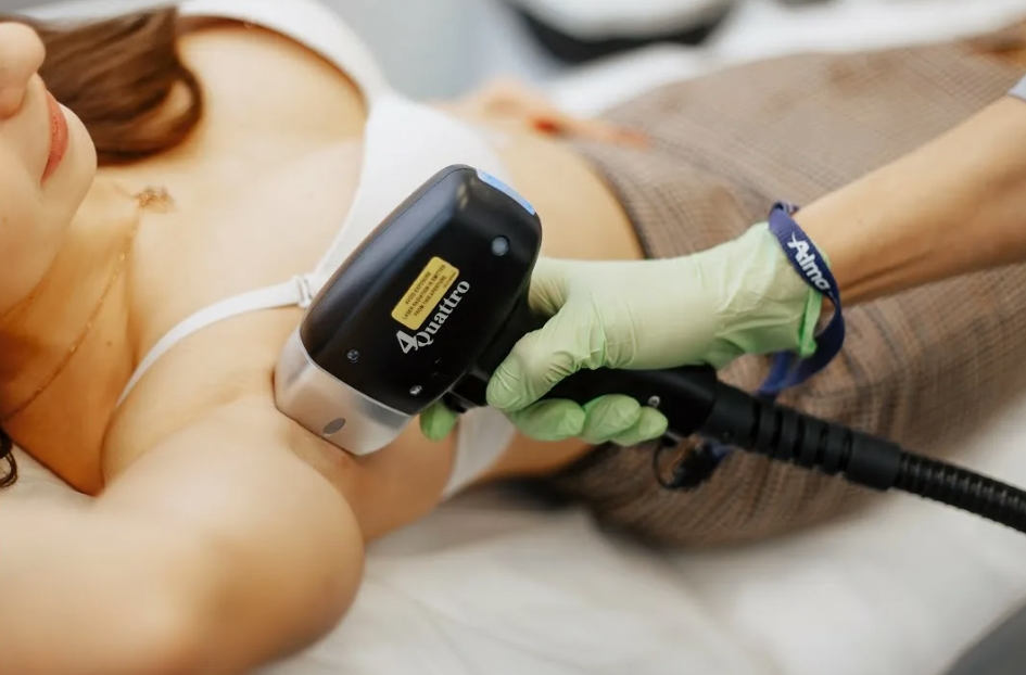 Лазерная эпиляция подмышек на аппарате Сопрано Титаниум